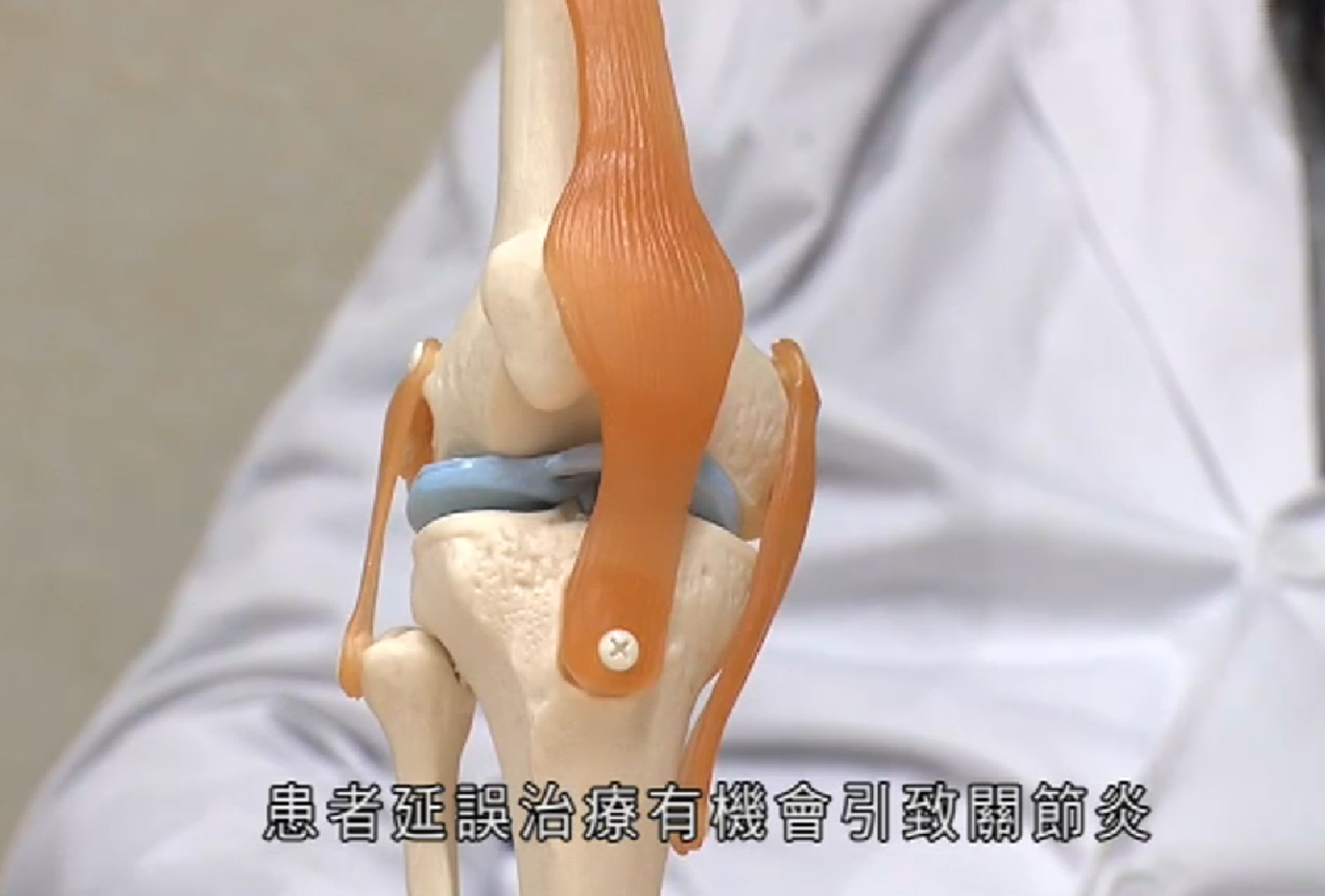 【短片】「菠蘿蓋脫位」 延誤治療或引發關節炎