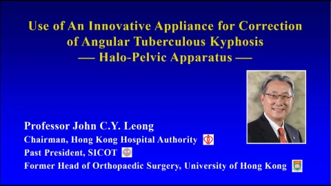 【Video】 Halo-Pelvic Apparatus