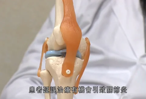 【短片】「菠蘿蓋脫位」 延誤治療或引發關節炎