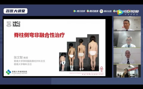 脊柱外科專家共談青少年脊柱側彎的防治