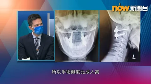 【杏林在線】慎防寰樞椎旋轉脫位