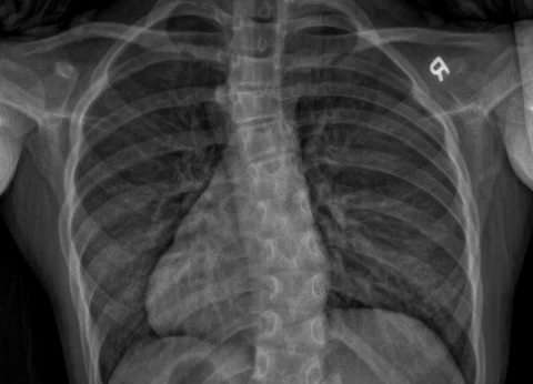 Novel supine correction index helps predict brace outcomes in adolescent idiopathic scoliosis patients